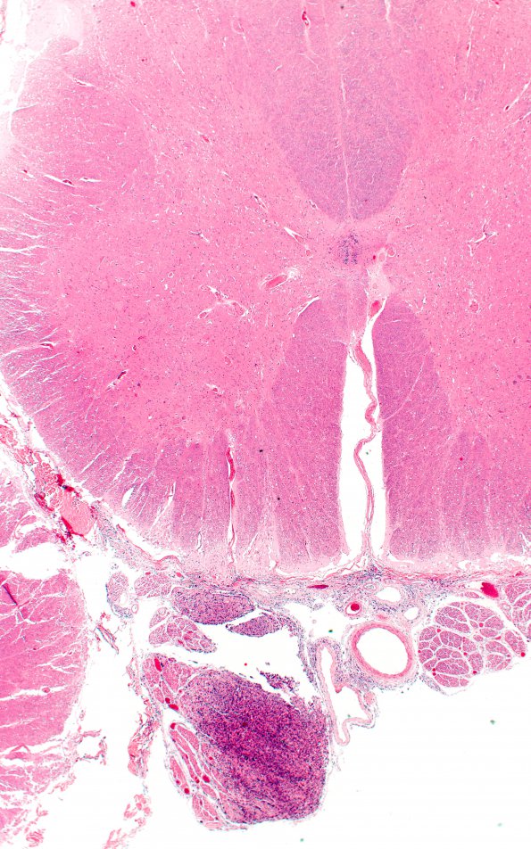 3D2 Carcinoma, renal, lepto (Case 3) N10 2X