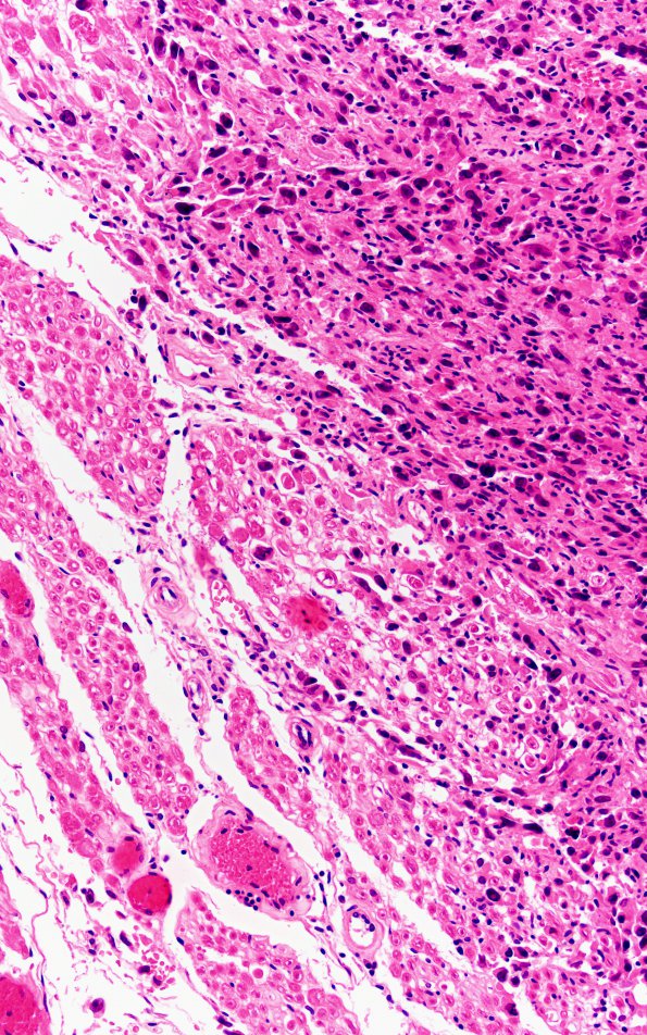 3D3 Carcinoma, renal, lepto (Case 3) N10 20X A