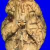 4A1 Metastases (Case 4) Gross 6