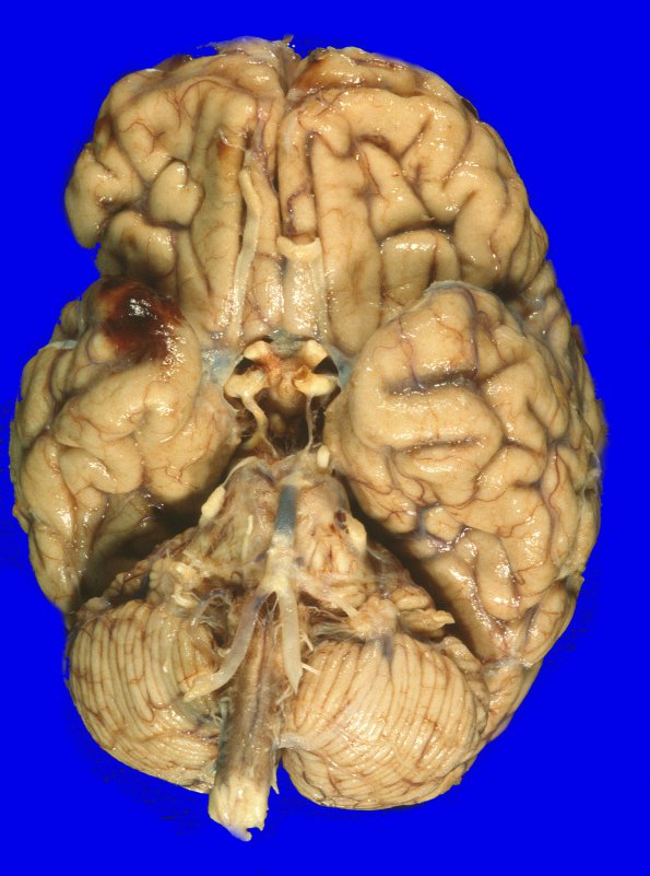 4A1 Metastases (Case 4) Gross 6