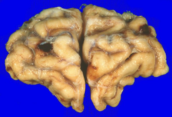 4A2 Metastases (Case 4) Gross 4