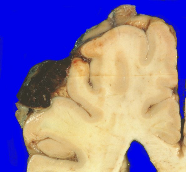 4A4 Metastases (Case 4) Gross 1 A