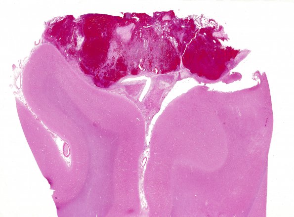 4B1  Metastases (Case 4) b