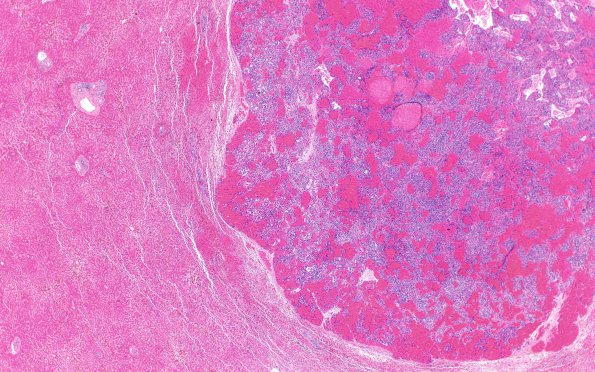 4B2 Metastases (Case 4) H2 2X