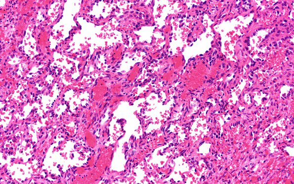 4B3 Metastases (Case 4) N12 20X