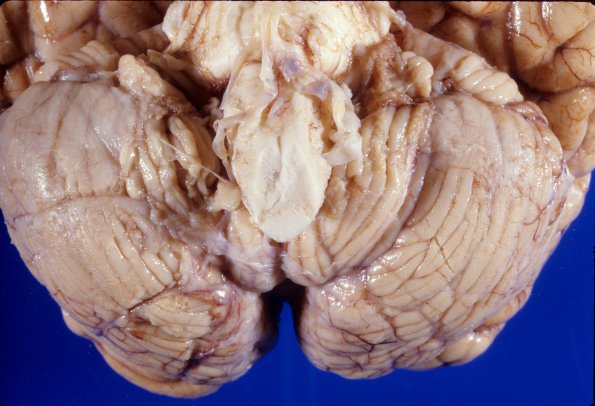 5A1 Metastases breast CA (Case 5) 2