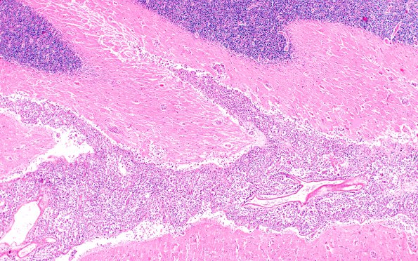 5A4 Metastases breast CA (Case 5) A 4X