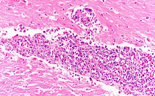 5A5 Metastases breast CA (Case 5) A 20X