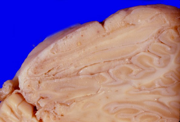 5B2 Metastases, breast, carcinomatosis (Case 5)