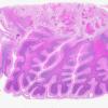 5B3 Metastases breast CA (Case 5) A