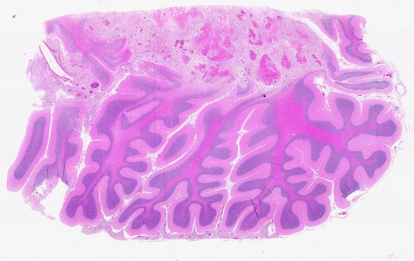 5B3 Metastases breast CA (Case 5) A