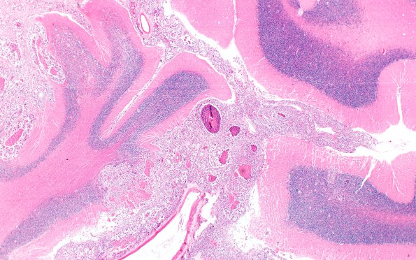 5B4 Metastases breast CA (Case 5) A 2X 2