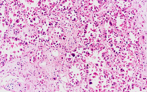 5B5 Metastases breast CA (Case 5) A 20X 2