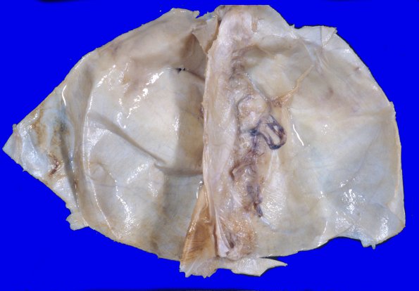 6A1 Metastasis, lung (Case 6) 3