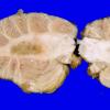 6A2 Metastasis, lung (Case 6) 6