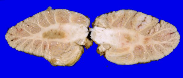 6A2 Metastasis, lung (Case 6) 6