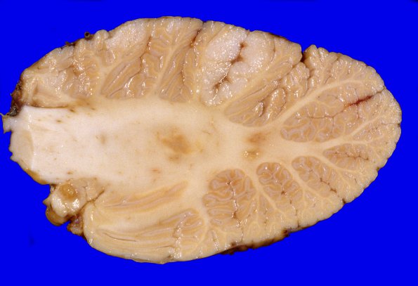 6A3 Metastasis, lung (Case 6) 7