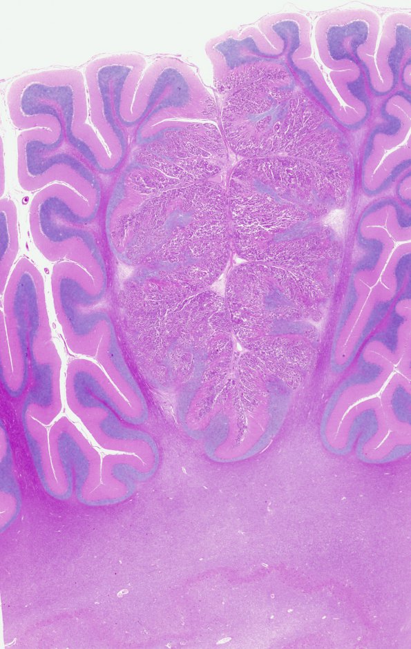 6B1 Metastatic CA6 (Case 6)