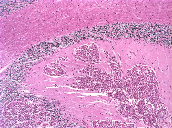 6B2 Metastatic CA2 (Case 6)