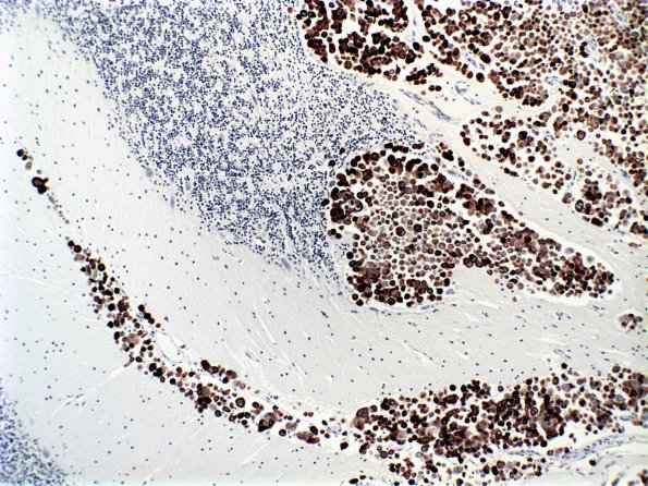 6B3 Metastatic CA CK7 (Case 6)