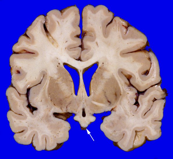 6C1 Metastases (Case 6) CA3 copy