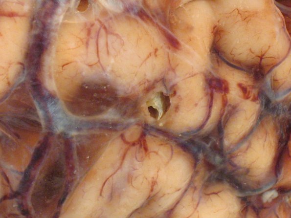 7A1 Metastases (Case 7) leptomeningeal, breast origin gross 1