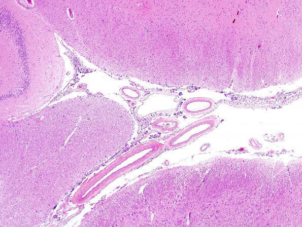 7B1 Metastases leptomeningeal, breast origin (Case 7)  6