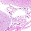 7B2 Metastases leptomeningeal, breast origin (Case 7)  7