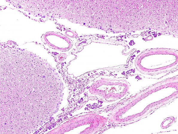 7B2 Metastases leptomeningeal, breast origin (Case 7)  7