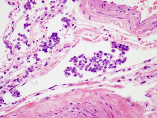 7B3 Metastases leptomeningeal, breast origin (Case 7)  5