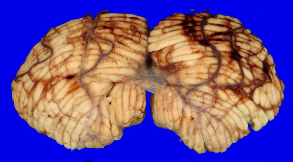 7C Metastases leptomeningeal, breast origin (Case 7) Gross 3