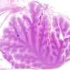 7D1 Metastases leptomeningeal, breast origin (Case 7) WM