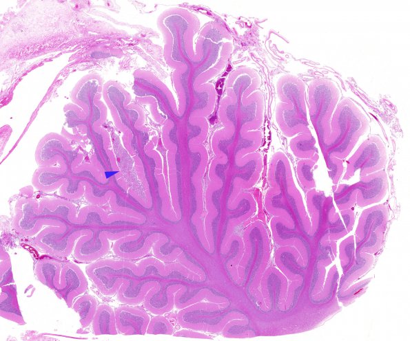 7D1 Metastases leptomeningeal, breast origin (Case 7) WM