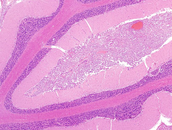 7D2 Metastases leptomeningeal, breast origin (Case 7) 4