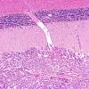 7D3 Metastases leptomeningeal, breast origin (Case 7) 8