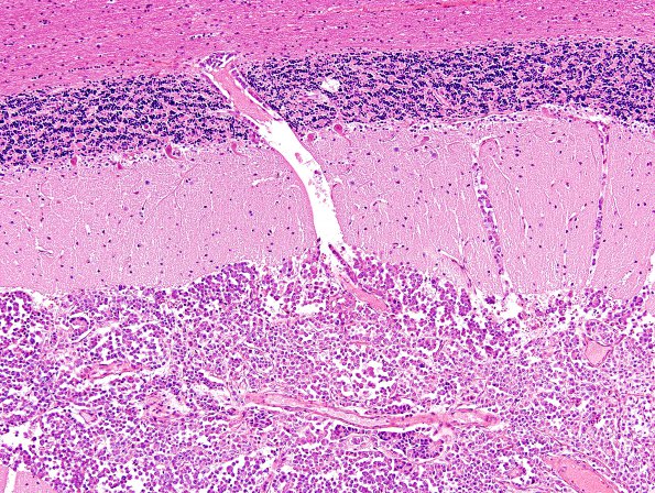 7D3 Metastases leptomeningeal, breast origin (Case 7) 8