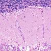 7D4 Metastases leptomeningeal, breast origin (Case 7) 3