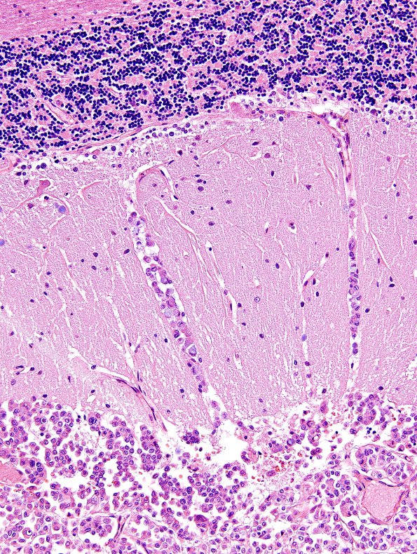 7D4 Metastases leptomeningeal, breast origin (Case 7) 3