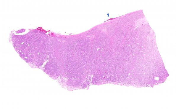 8A1 Metastasis, subdural, prostate (Case 8) H&E WM