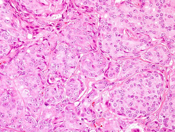 8A4 Metastasis, subdural, prostate (Case 8) H&E 5.jpg