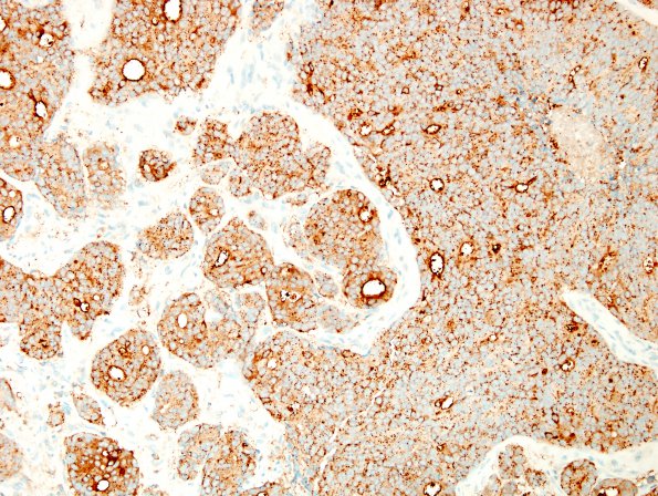 8B1 Metastasis, subdural, prostate (Case 8) PSAP 1.jpg