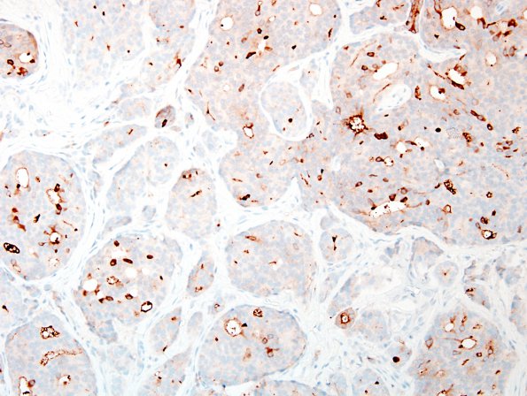 8C1 Metastasis, subdural, prostate (Case 8) PSA 1.jpg