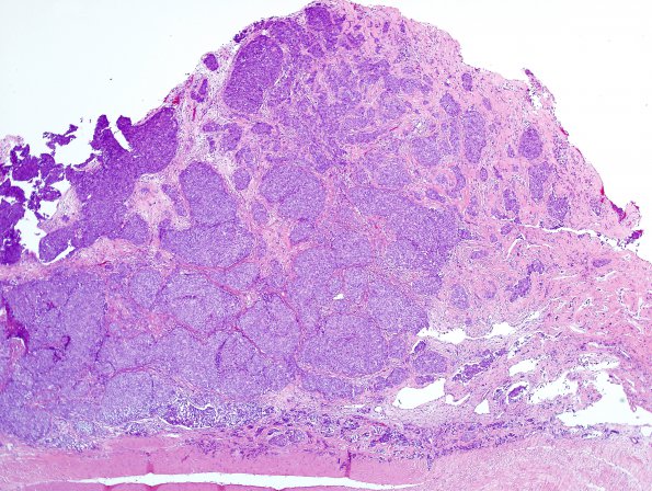 9A2 Metastasis, dura, (Case 9) H&E 1