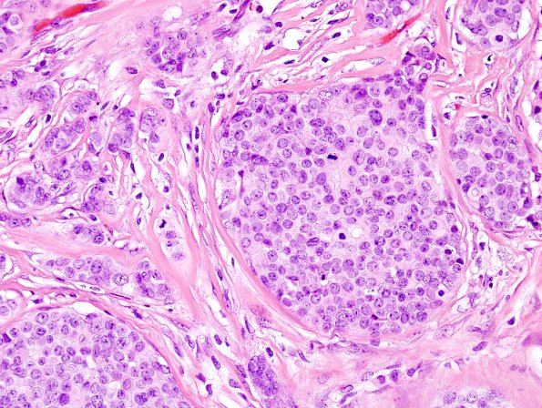 9A3 Metastasis, dura, (Case 9) H&E 4