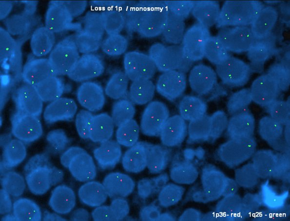 9B1 Metastasis, dura, (Case 9) loss of 1 - Copy