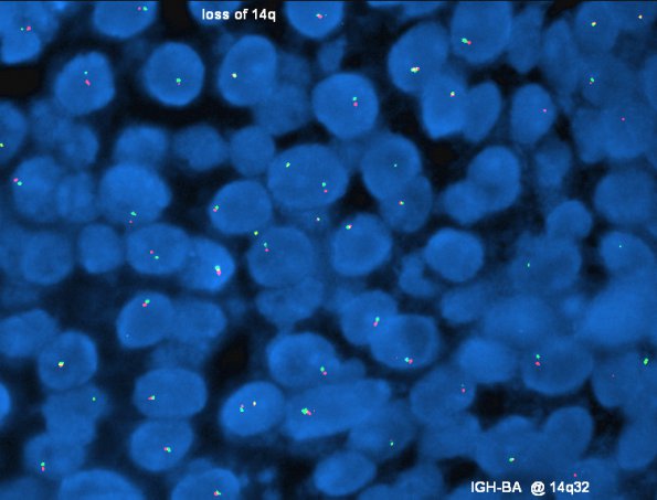 9B2 Metastasis, dura, (Case 9) loss of 14q - Copy