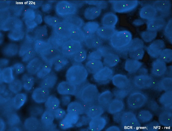 9B3 Metastasis, dura, (Case 9) loss of 22q - Copy