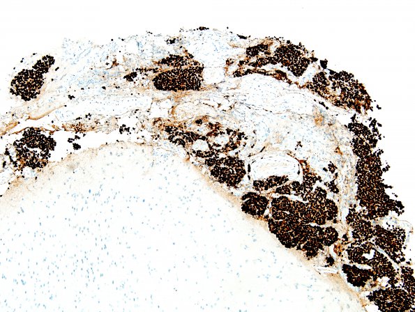 9C1 Metastasis, dura, (Case 9) ER 2