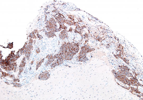 9C2 Metastasis, dura, (Case 9) HER-2 1