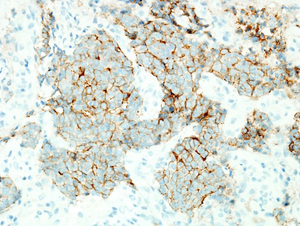 9C3 Metastasis, dura, (Case 9) HER-2 3